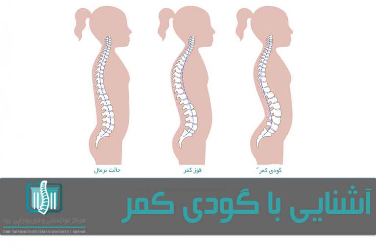 درمان گودی کمر یا لوردوز با فیزیوتراپی و ورزش Yazd Physiotherapy Center