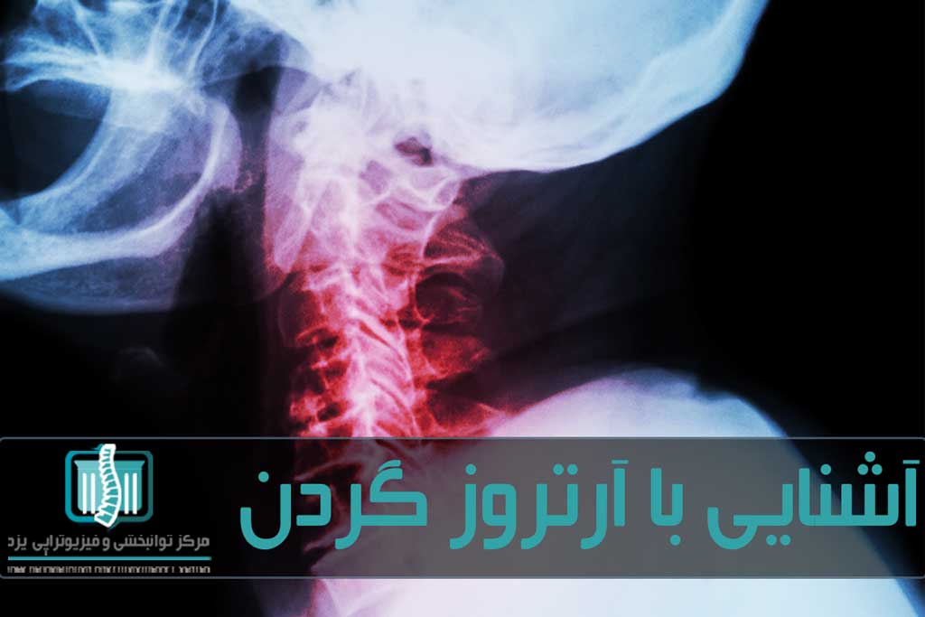 آرتروز گردن بیماری مفصل‌های ناحیه گردن ستون فقرات است