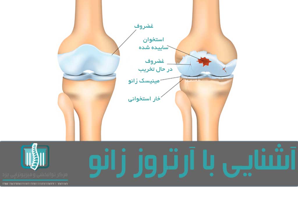 مفصل زانو استخوان ساق پا را به استخوان ران وصل می‌کند و شامل رباط‌ها، تاندون‌ها و غضروف مفصل است