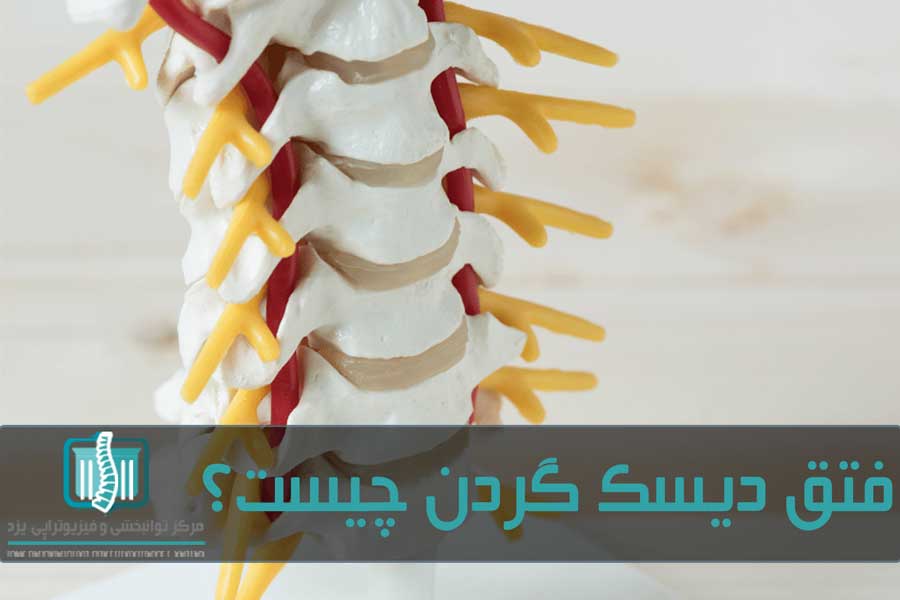 بیرون‌زدگی یا پارگی دیسک گردن باعث بروز درد و گرفتگی در گردن می‌شود
