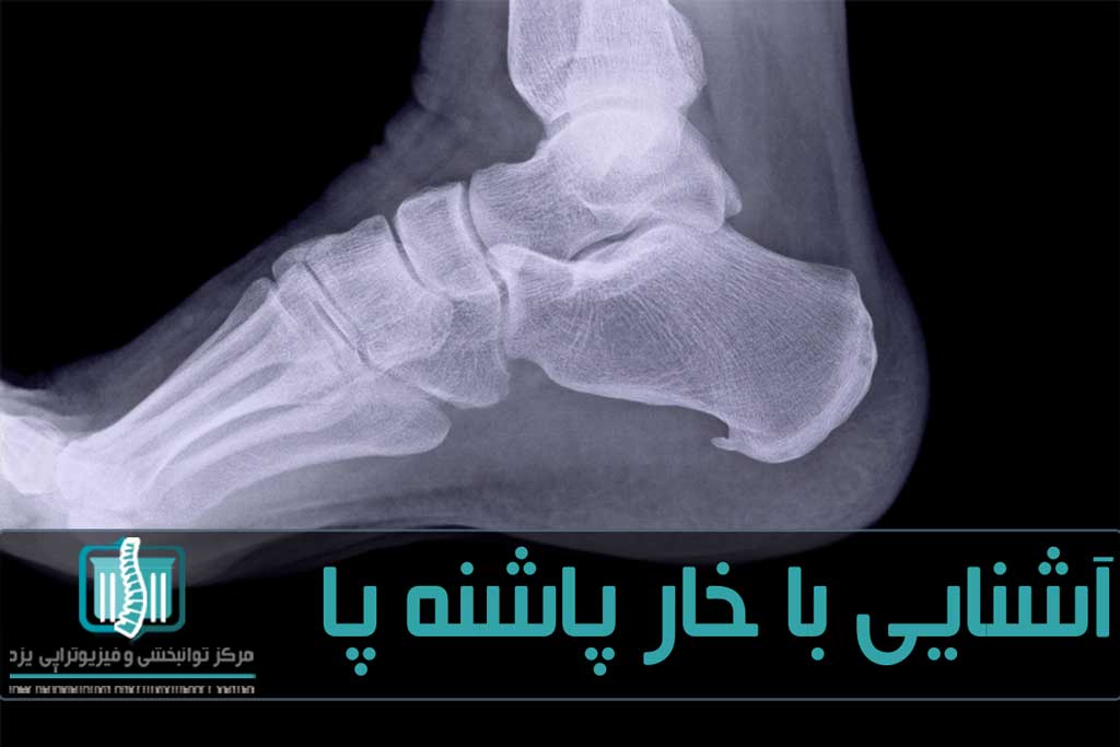 رباط‌های کف پا در اثر فشار زیاد دچار پارگی می‌شوند که ممکن است در محل پارگی کلسیم رسوب کند و خار بوجود آید
