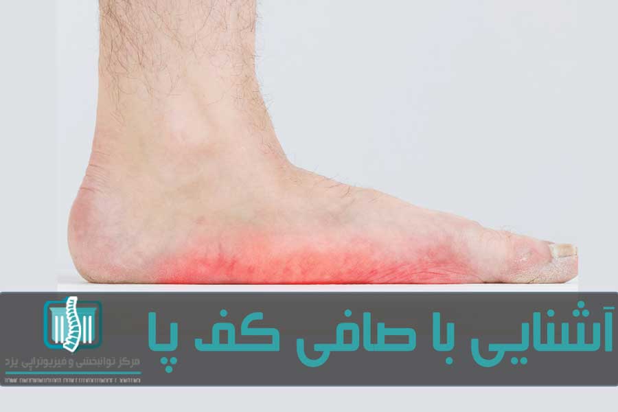 صافی کف پا حالتی است که در آن کف پا قوس ندارد یا میزان قوس آن کم است