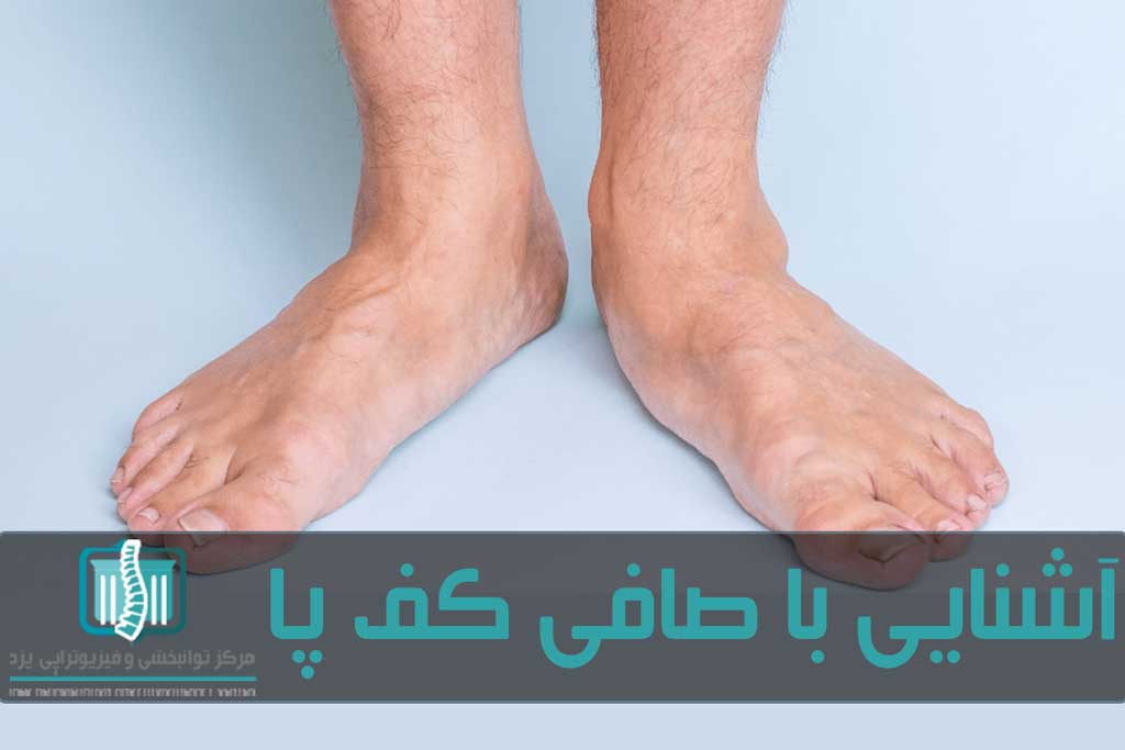 بی توجهی به کف پای صاف می‌تواند باعث درد در ساق پا، زانو و حتی لگن شود