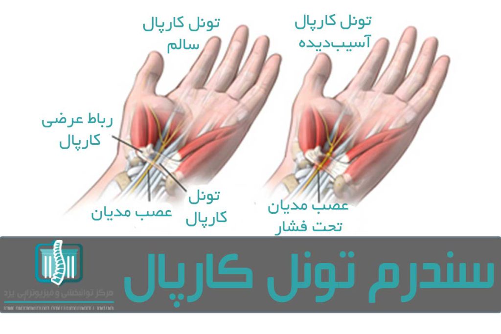 سندرم تونل کارپال در اثر فشار به عصب مدیان در مچ دست ایجاد می‌شود