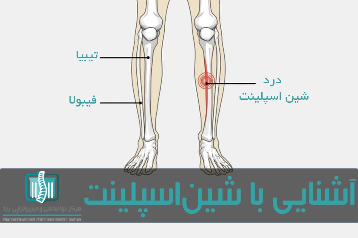 علت بروز شین اسپلینت فشار زیاد روی استخوان ساق پا است