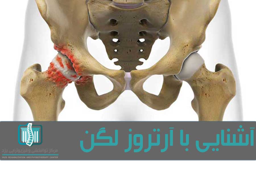 آرتروز در اثر تخریب غضروف و ساییدگی استخوان مفصل لگن ایجاد می شود